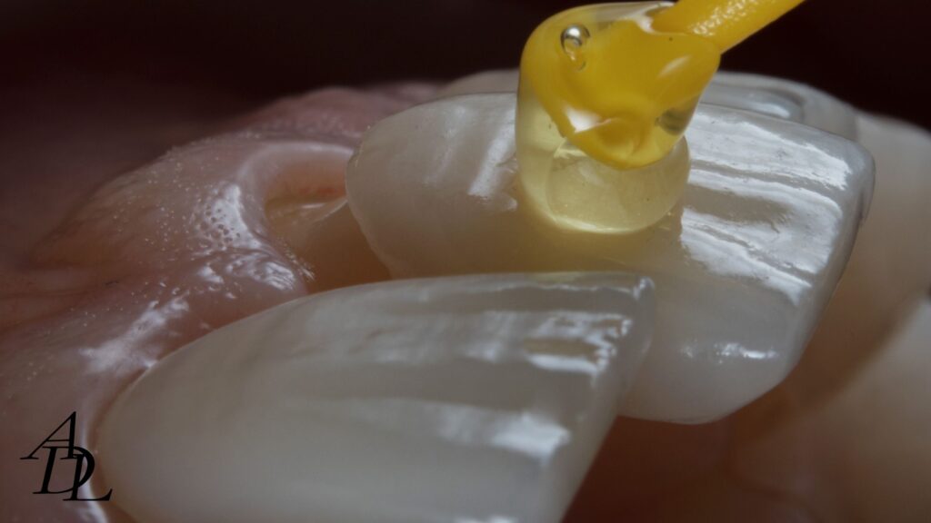 Clinician placing Veneer over front incisor